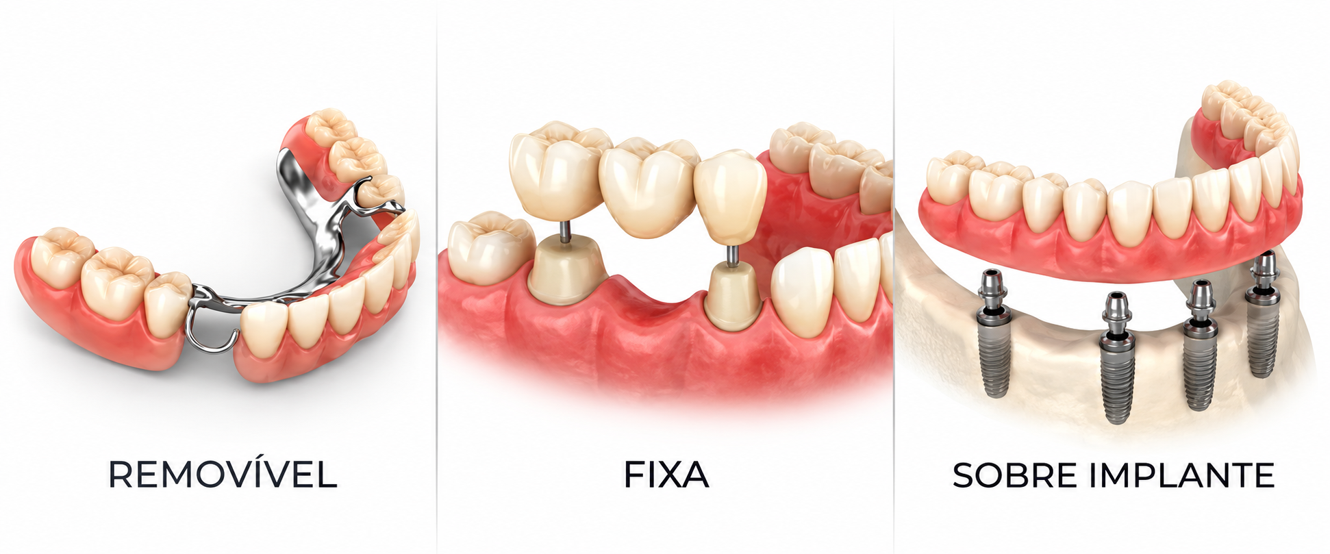 Tipos de prótese dentária: removível, fixa e sobre implante