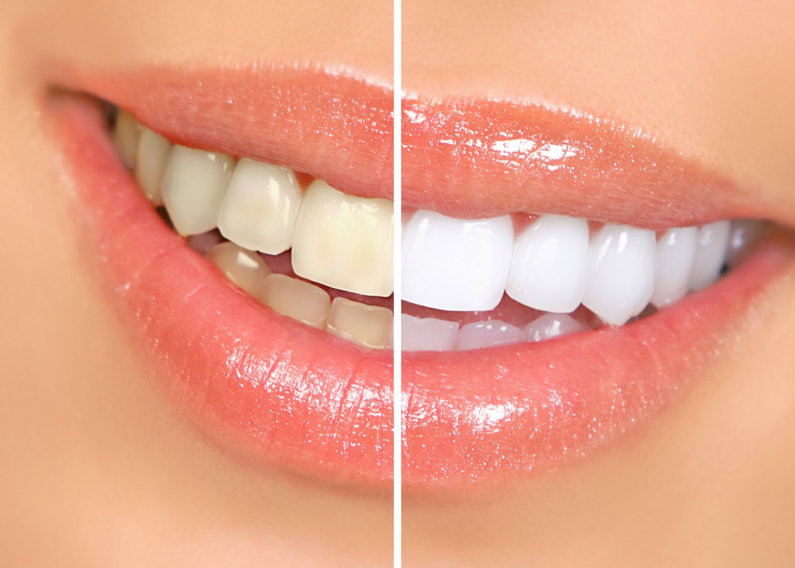 Clareamento dental com dentista em Canoas, RS