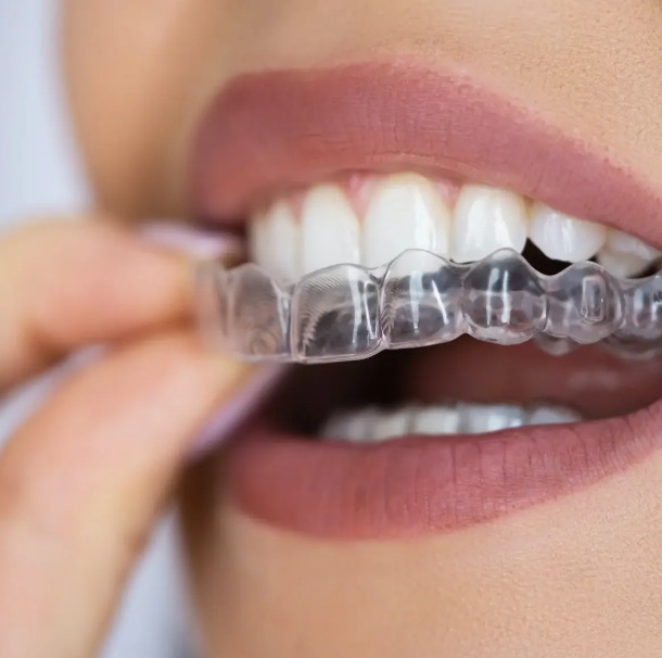 Alinhador transparente Invisalign