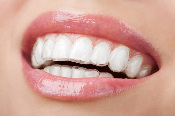 Tratamento com Invisalign