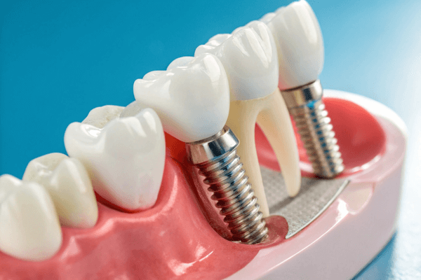 Tipos de prótese dentária com dentista em Canoas, RS